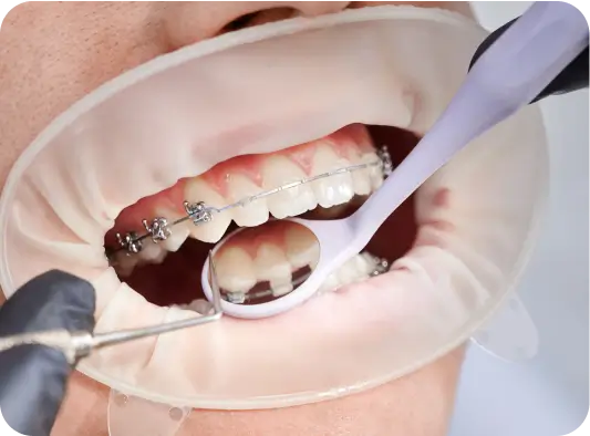 Warren - Braces can give you a perfect smile!